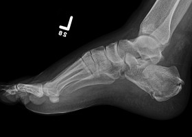 fractured heel bone
